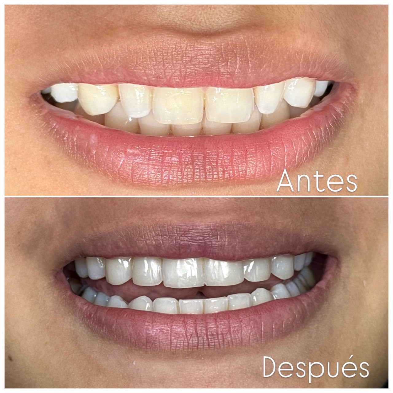 Antes y después de un diseño de sonrisa con carillas — paciente real