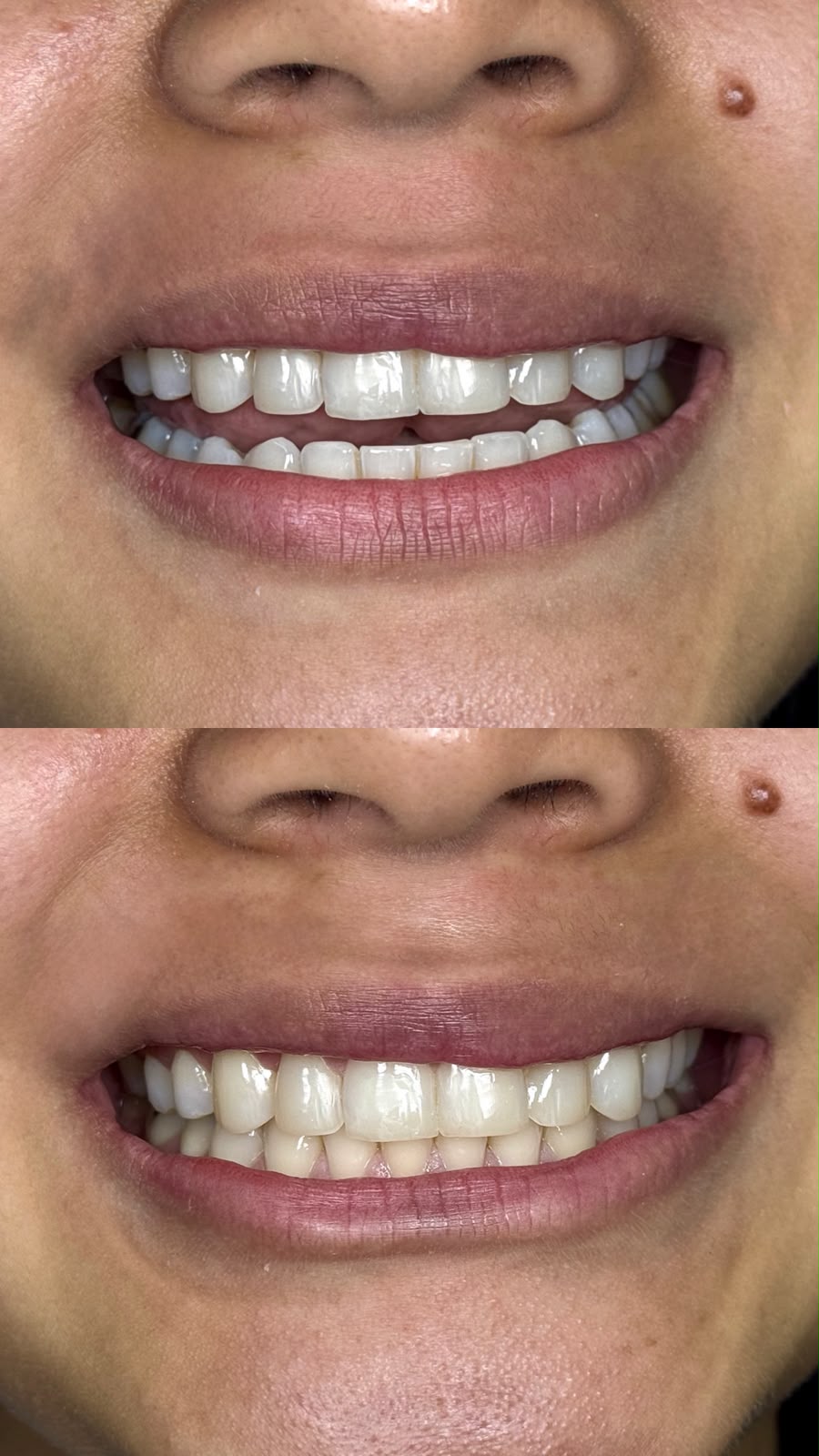 Antes y después de carillas de porcelana — paciente real