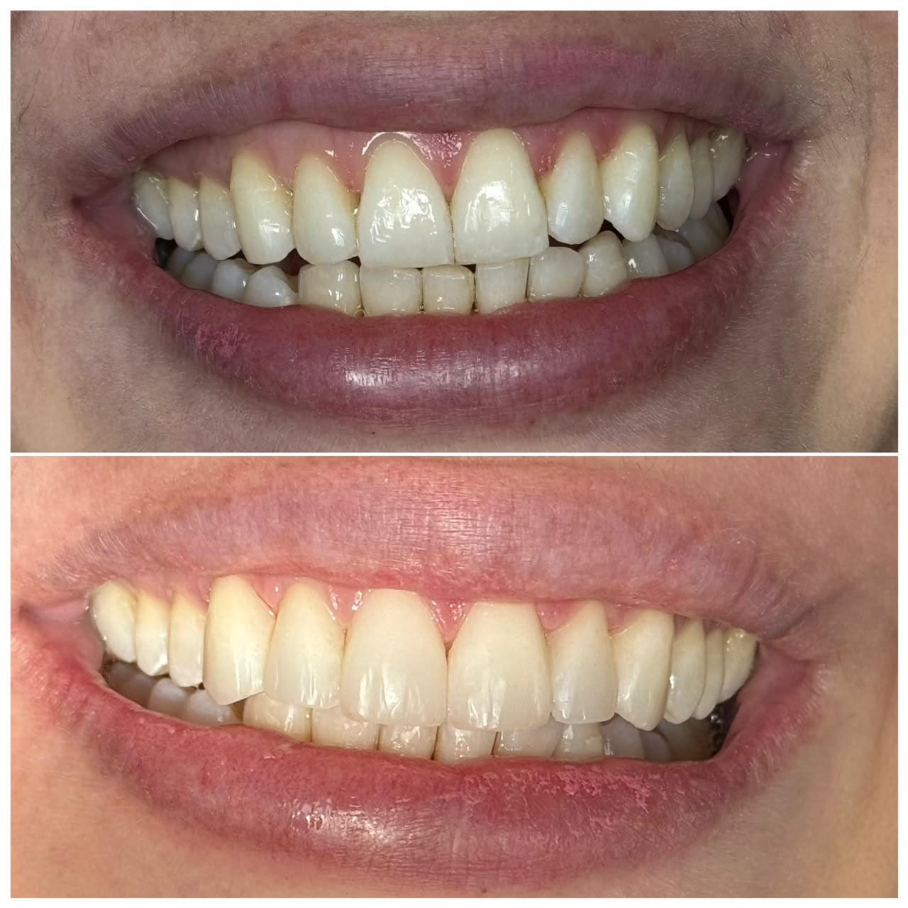 Antes y después de rejuvenecimiento de sonrisa — paciente real