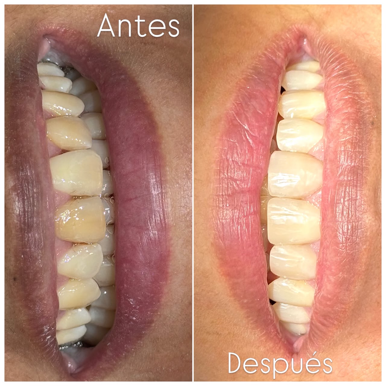 Antes y después de un aclaramiento dental — paciente real