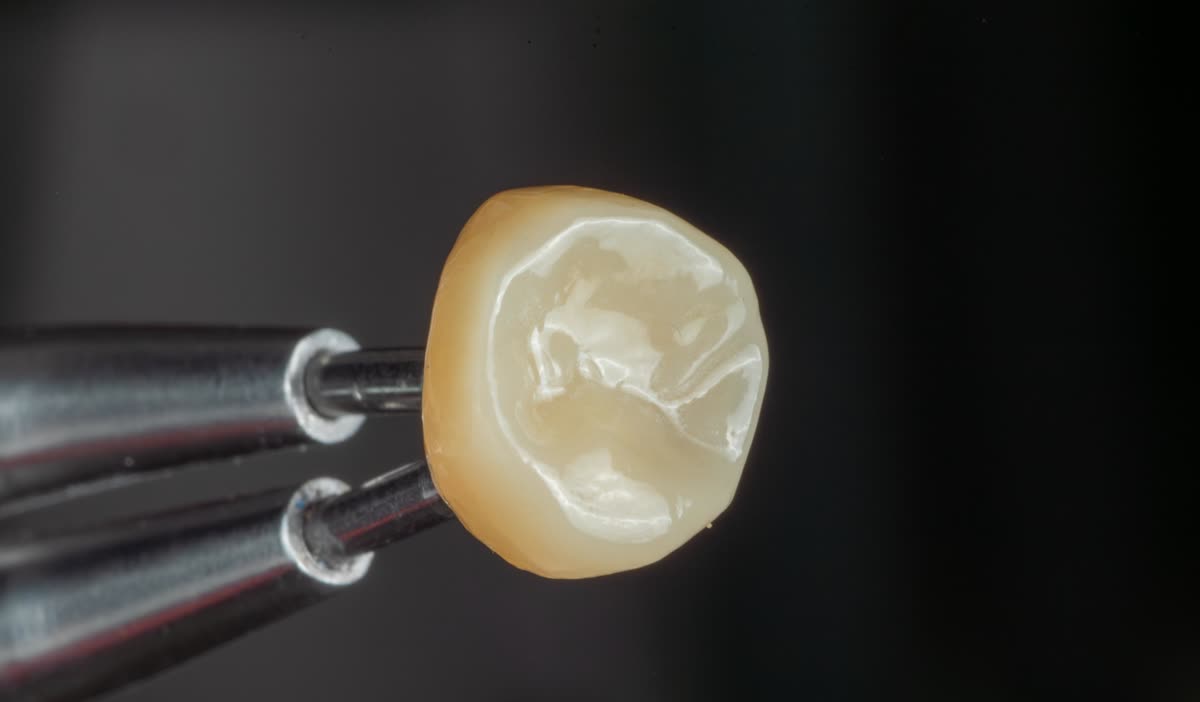 Carilla de porcelana — detalle del trabajo de laboratorio