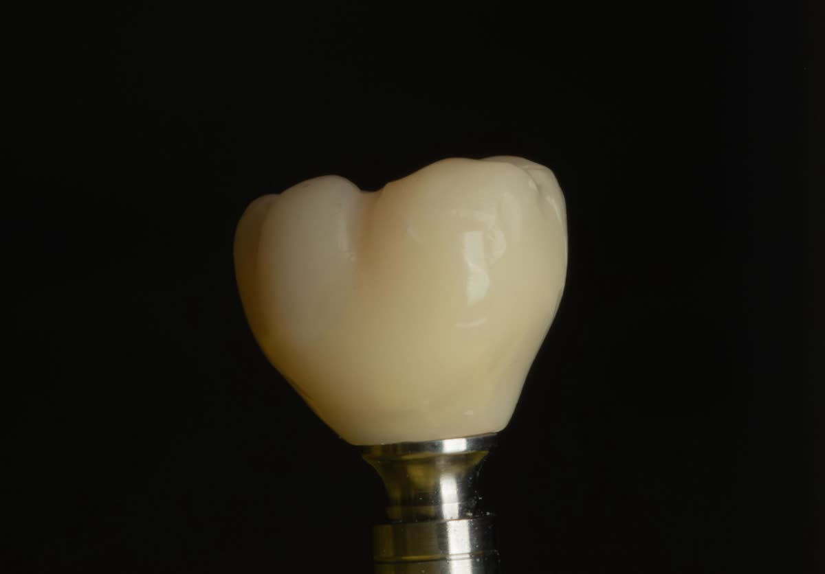 Corona de porcelana sobre implante — acabado natural