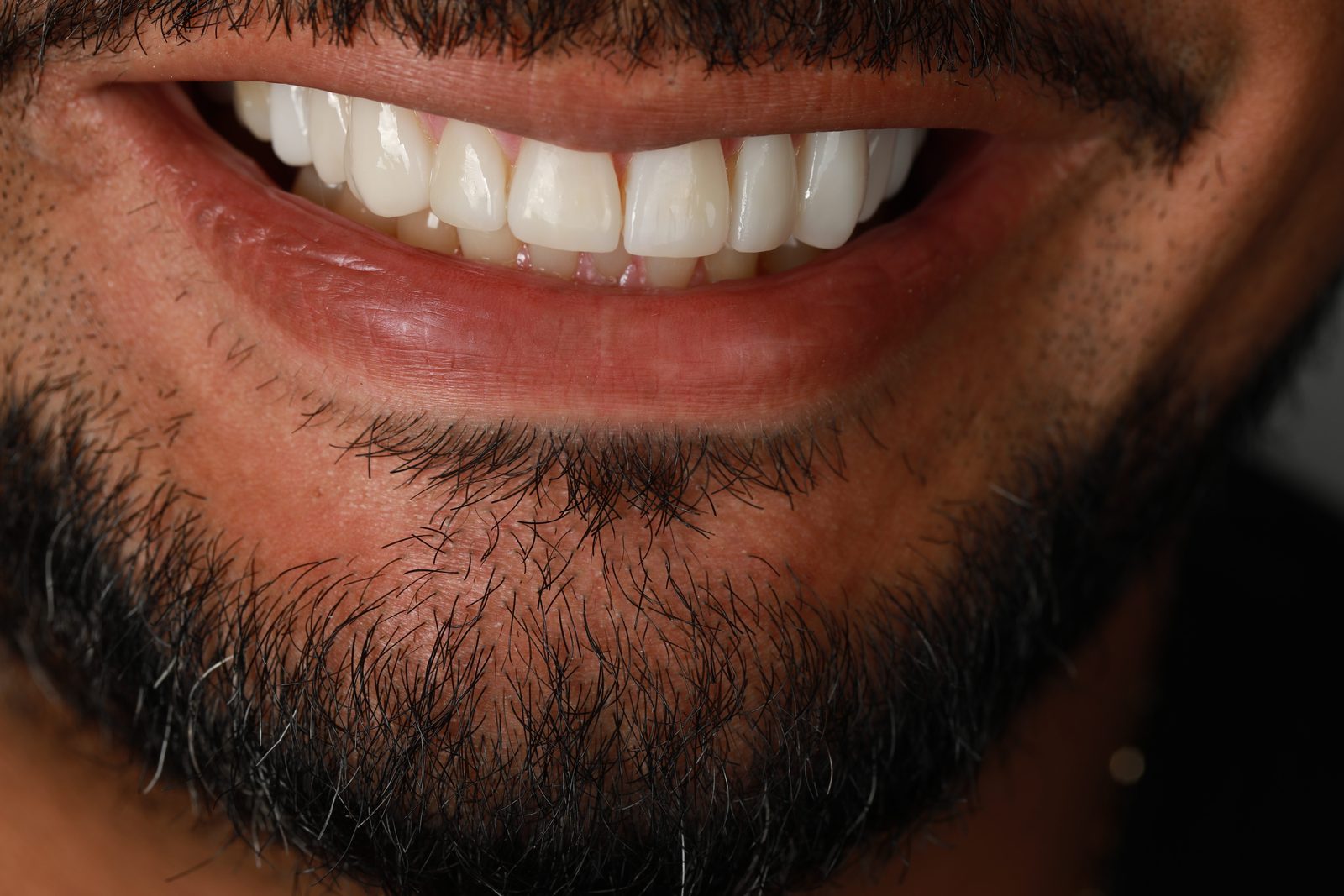 Caso 01 de carillas de porcelana — sonrisa de frente