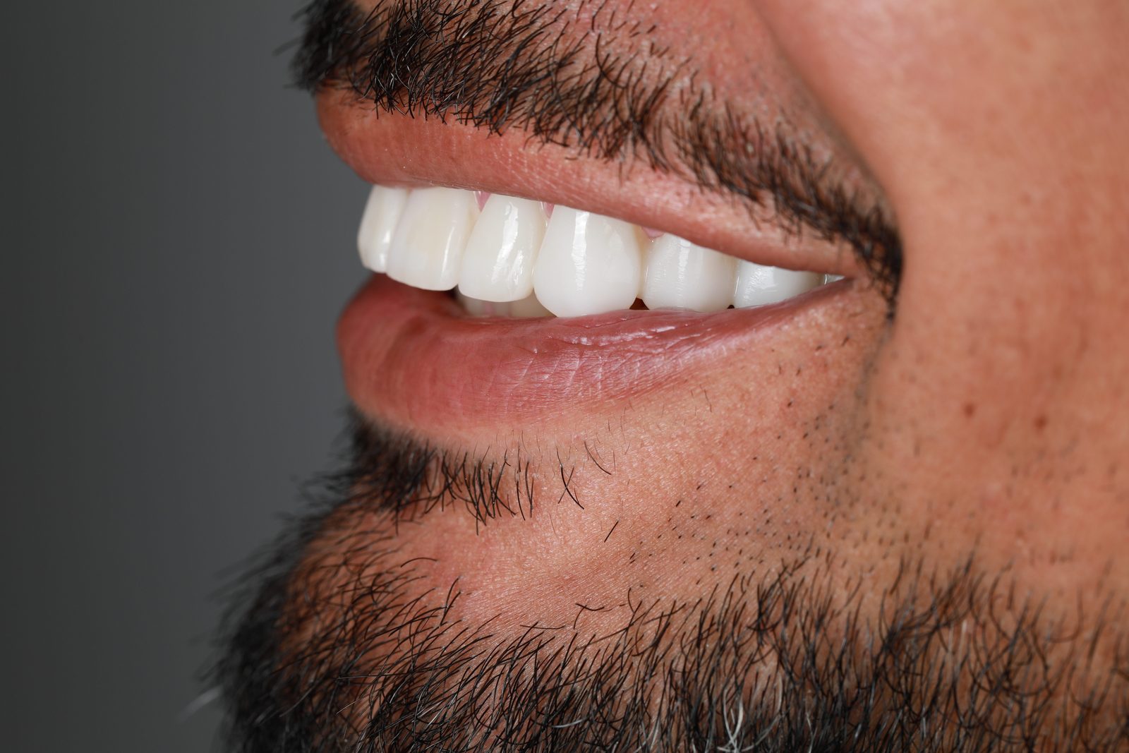 Perfil de una sonrisa con carillas de porcelana