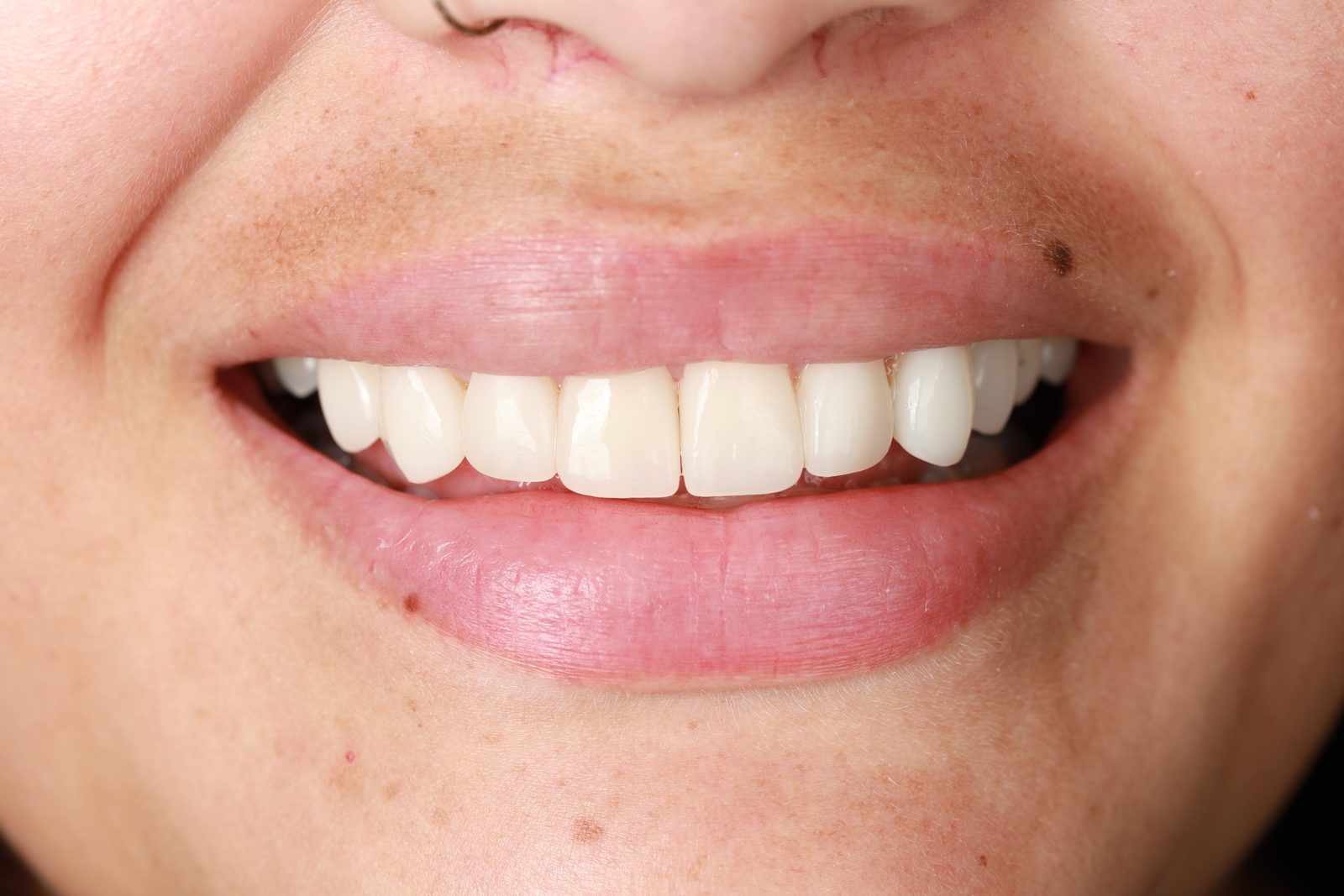 Sonrisa terminada con carillas de porcelana
